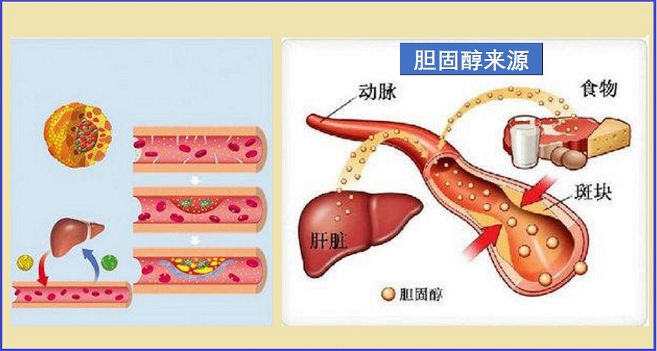 高胆固醇