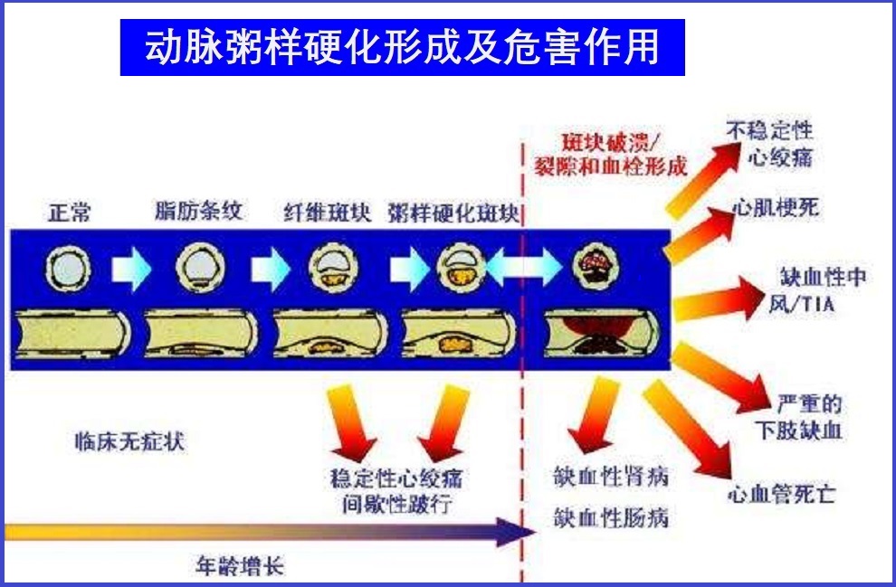  动脉粥样硬化