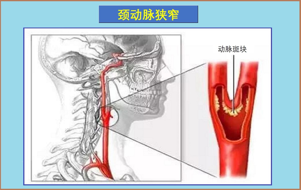  颈动脉疾病
