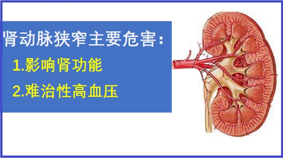  肾动脉狭窄