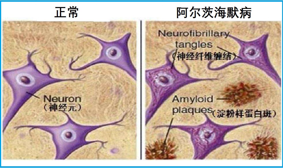 老年痴呆