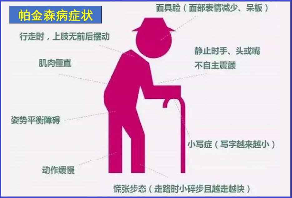  帕金森病