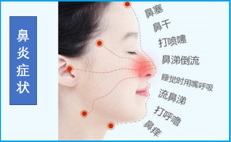  鼻窦炎