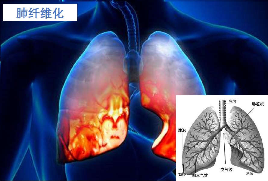  特发性肺纤维化