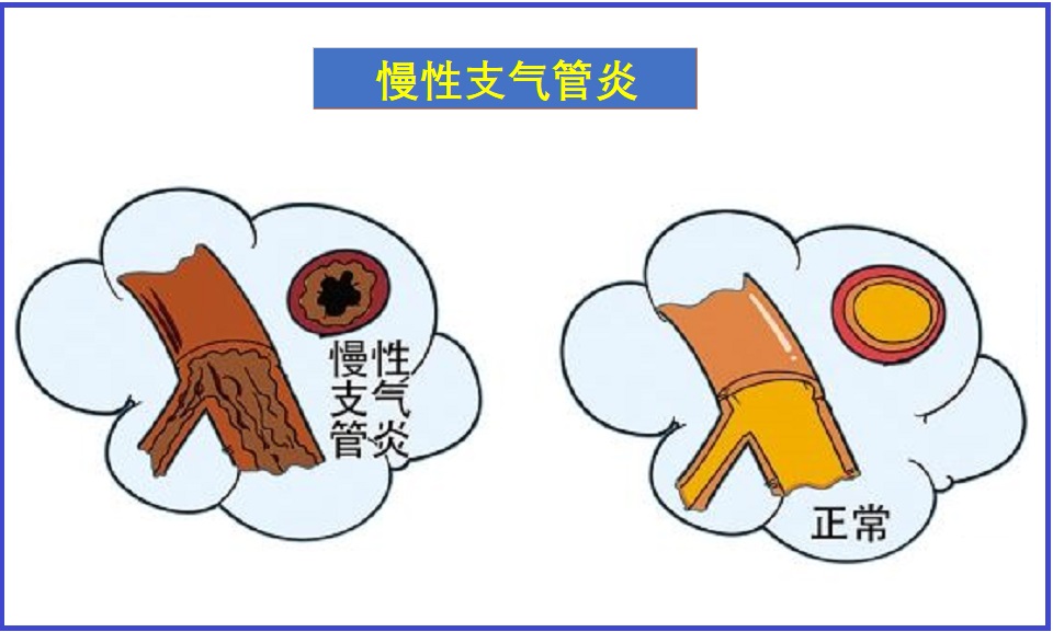  慢性支气管炎
