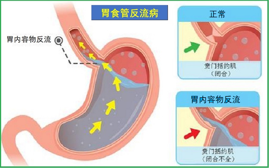  胃食管反流病