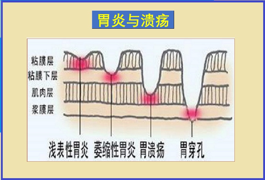  胃炎