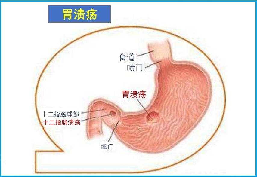  胃溃疡