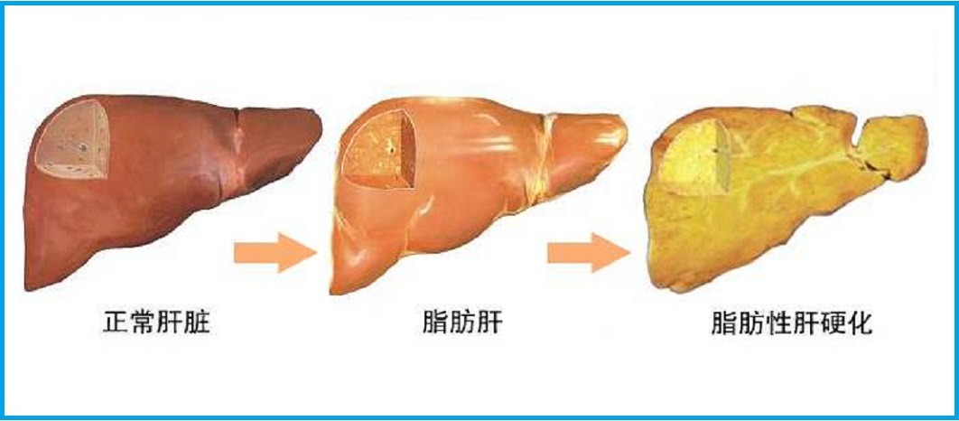  脂肪肝