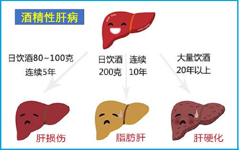  酒精性肝炎