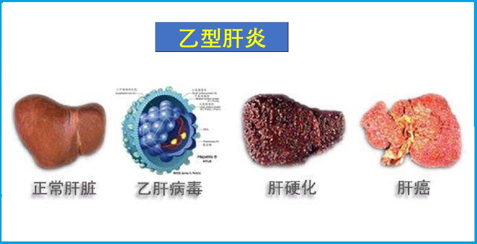  乙肝