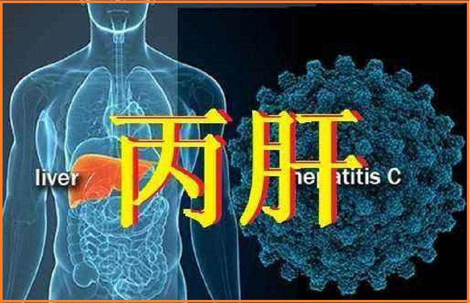  丙肝