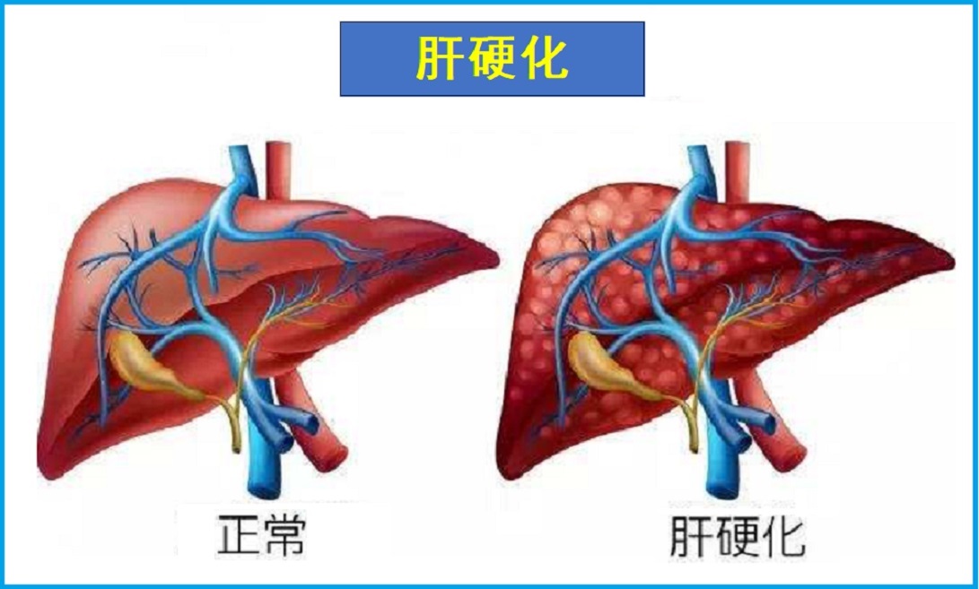  肝硬化