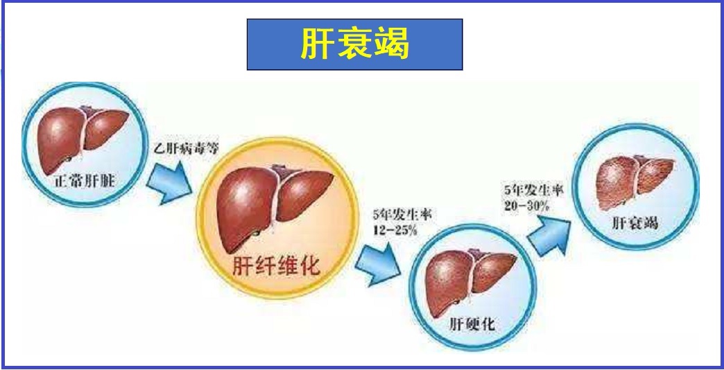  肝衰竭