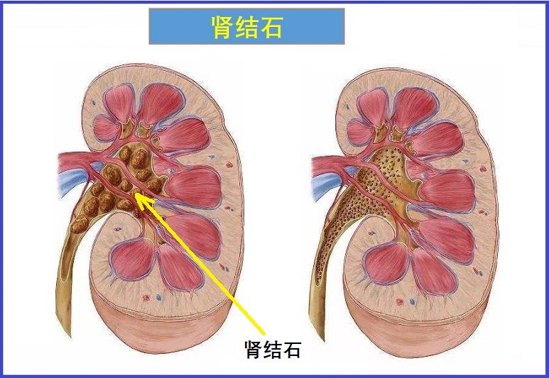  肾结石