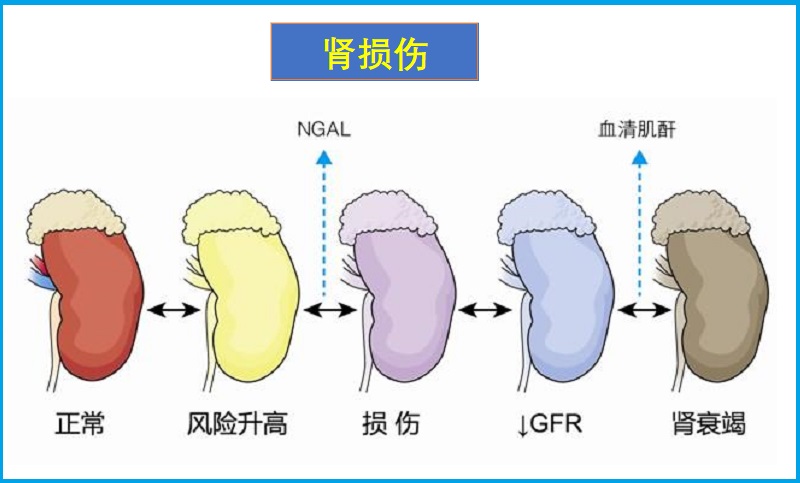  急性肾损伤