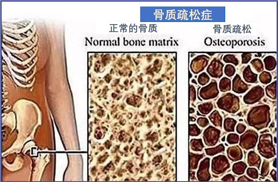  骨质疏松症