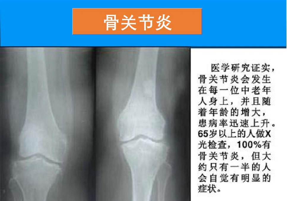  骨关节炎