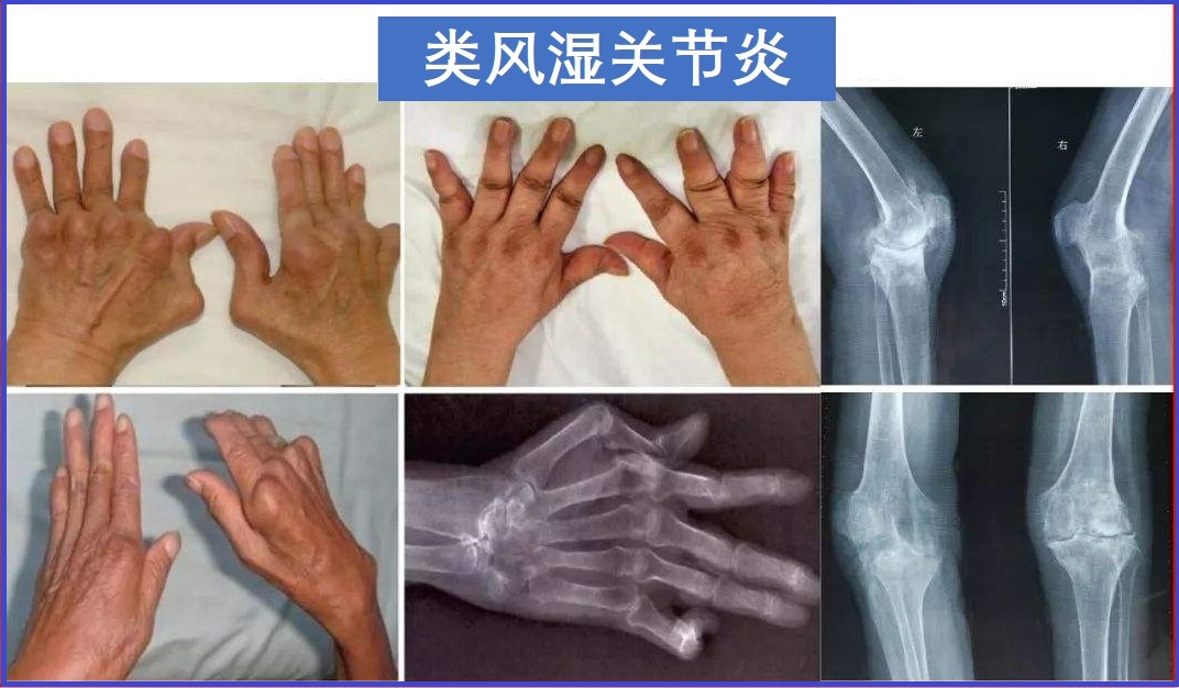  类风湿关节炎