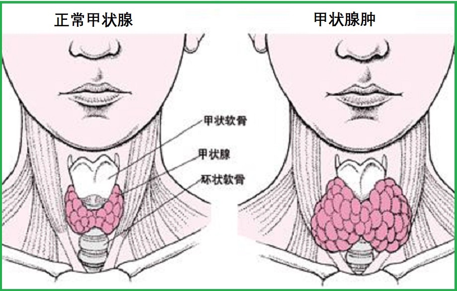  格雷夫斯病