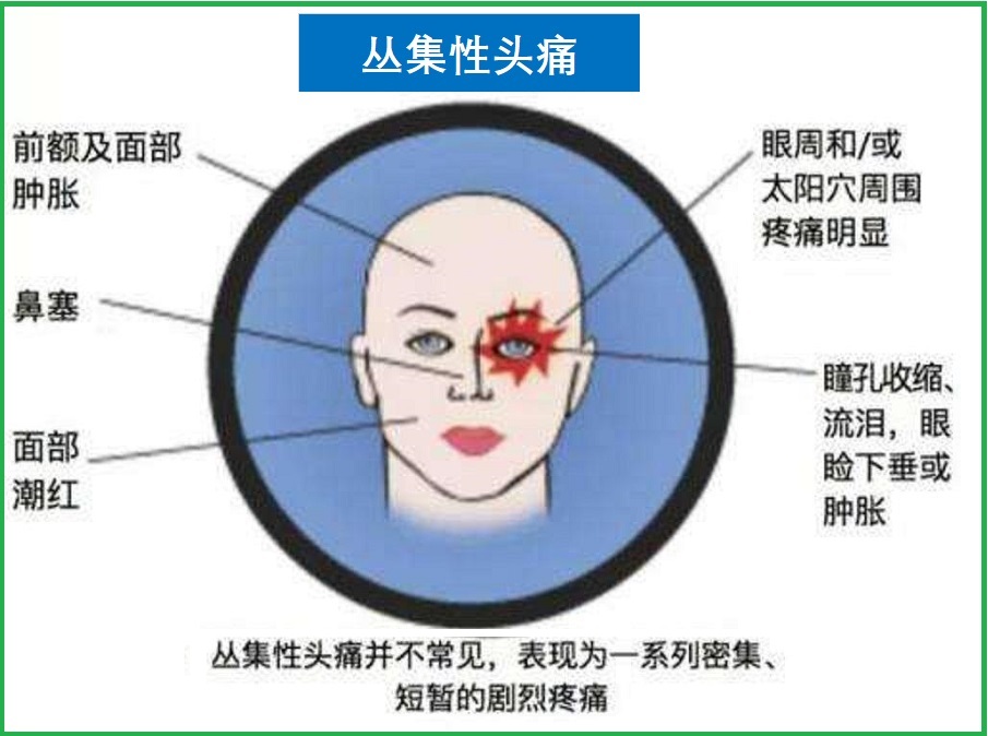  丛集性头痛