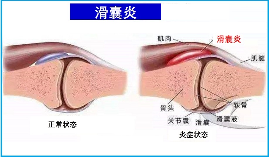  滑囊炎