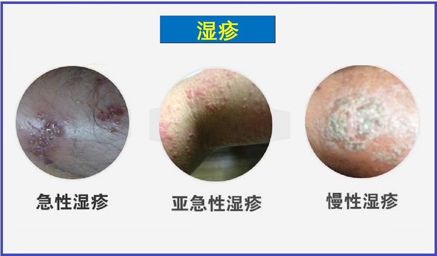  湿疹