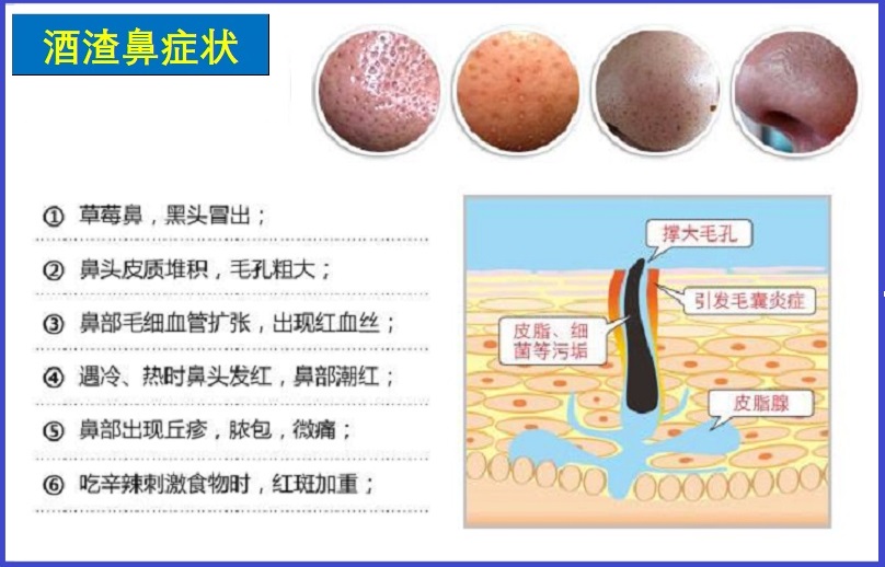  酒渣鼻
