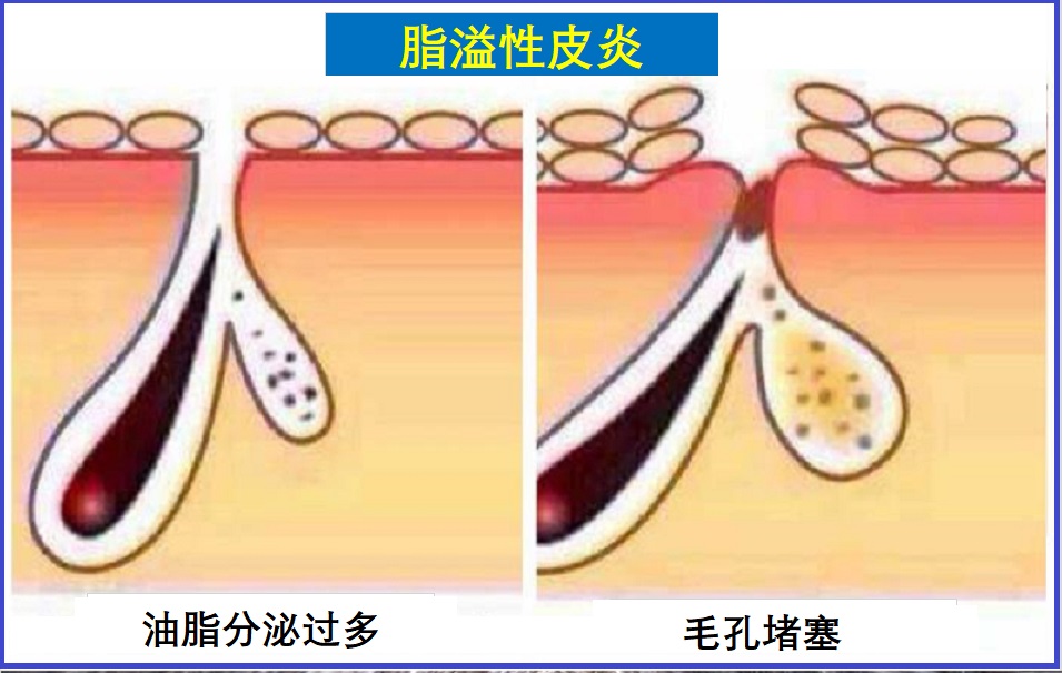  脂溢性皮炎