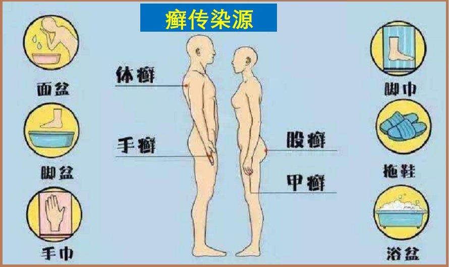  足癣