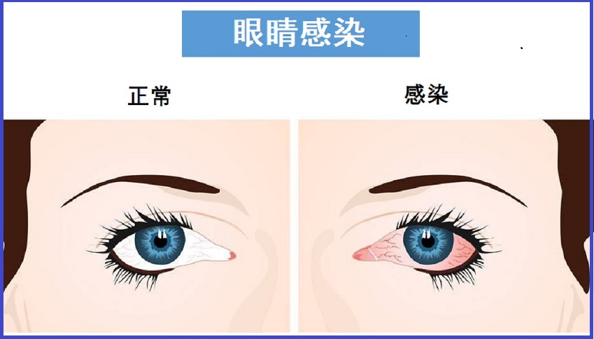  结膜炎