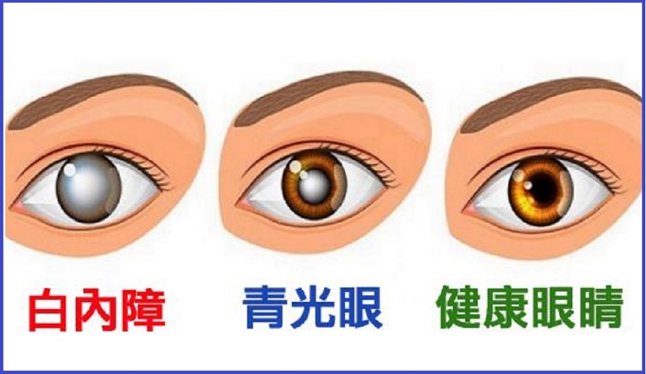  青光眼