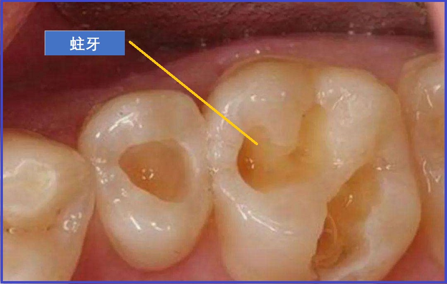  蛀牙