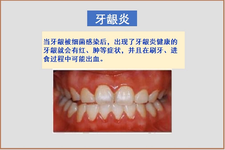  牙龈炎