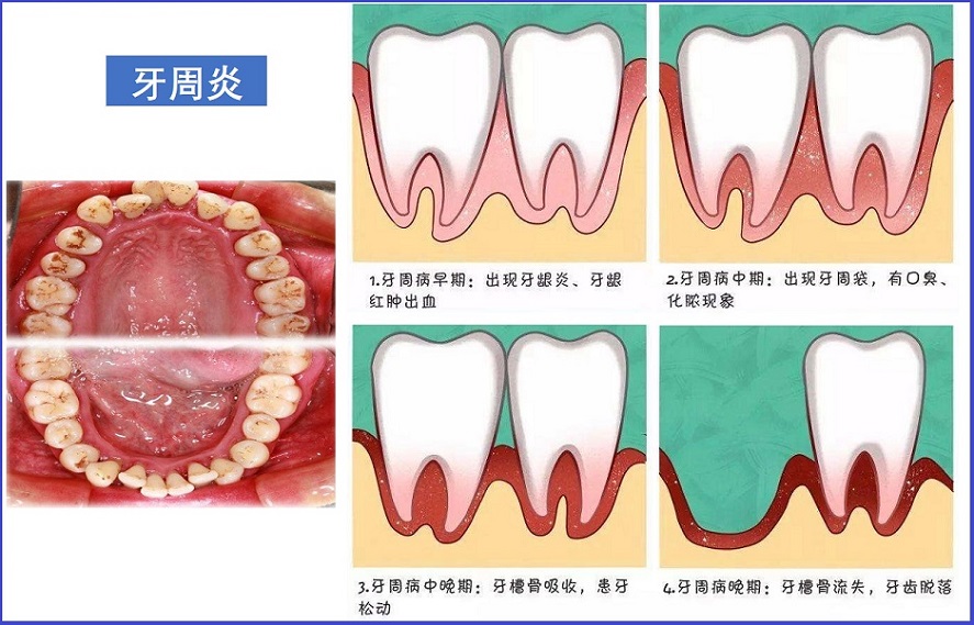 牙周炎