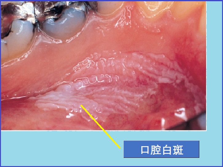  口腔白斑病