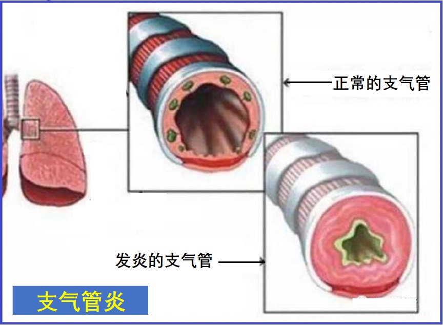  急性支气管炎