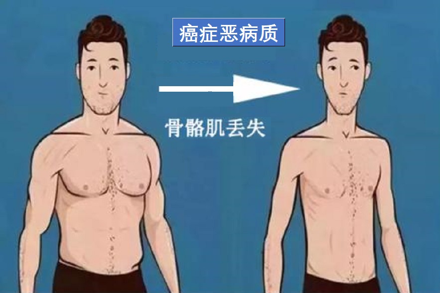  癌症恶病质