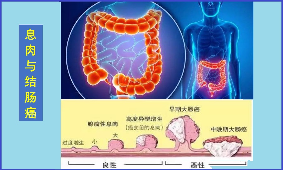  结肠癌