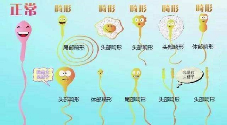  畸形精子症