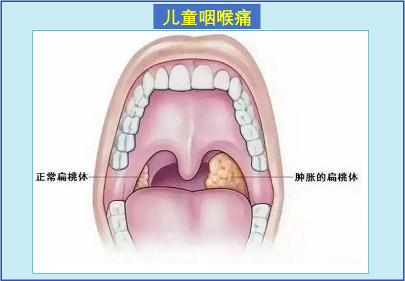  儿童喉咙痛