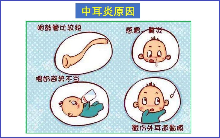  儿童中耳炎