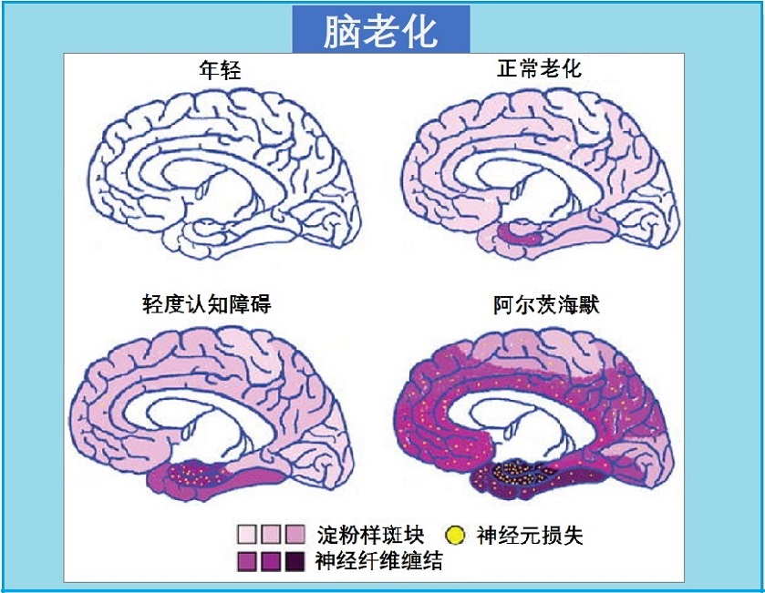  脑衰老管理