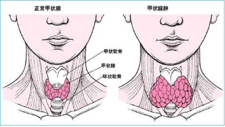  甲状腺肿